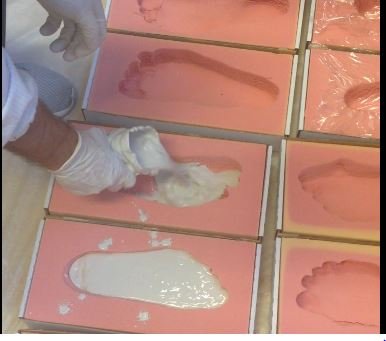 Colatura del gesso per la creazione del plantare Ortopedico