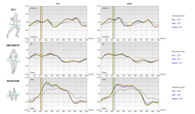 Risultati gait analysis con G-WALK