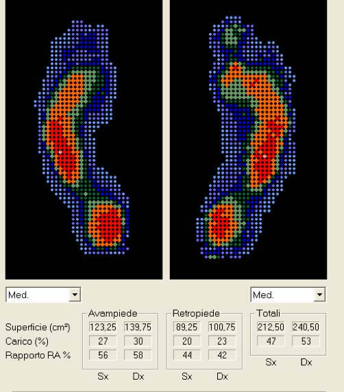 Esame baropodometrico dinamico post riabilitazione | Orthesys Milano