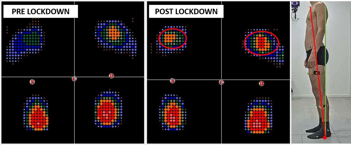 baropodometria pre e post lockdown