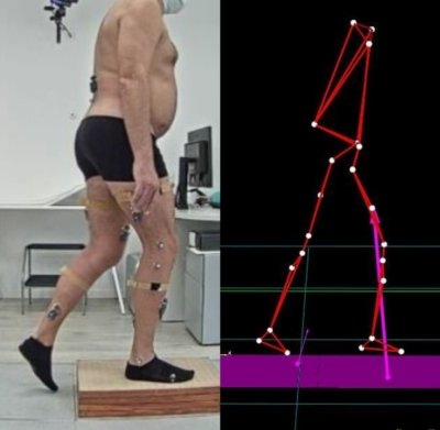 Gait analysis pazienti covid